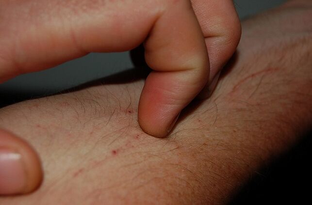 svědění kůže jako příznak přítomnosti parazitů