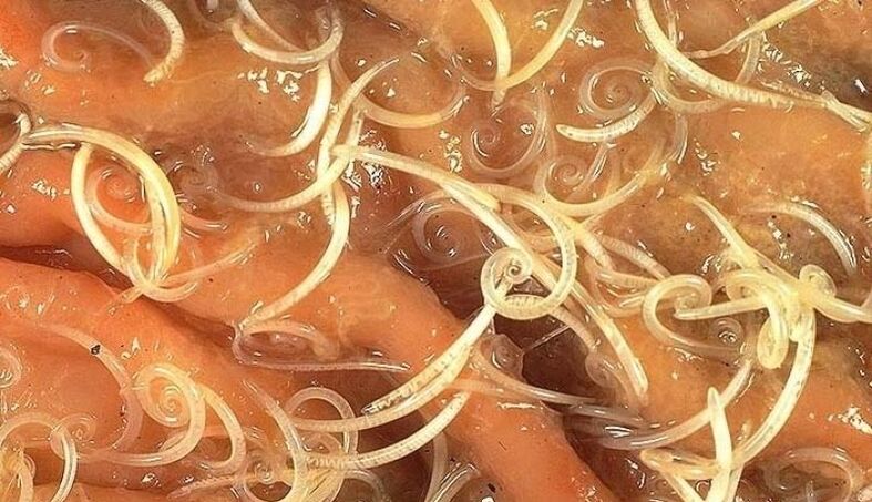 červy z lidského těla
